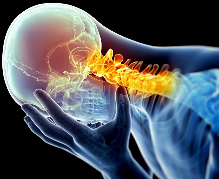 migraine-image