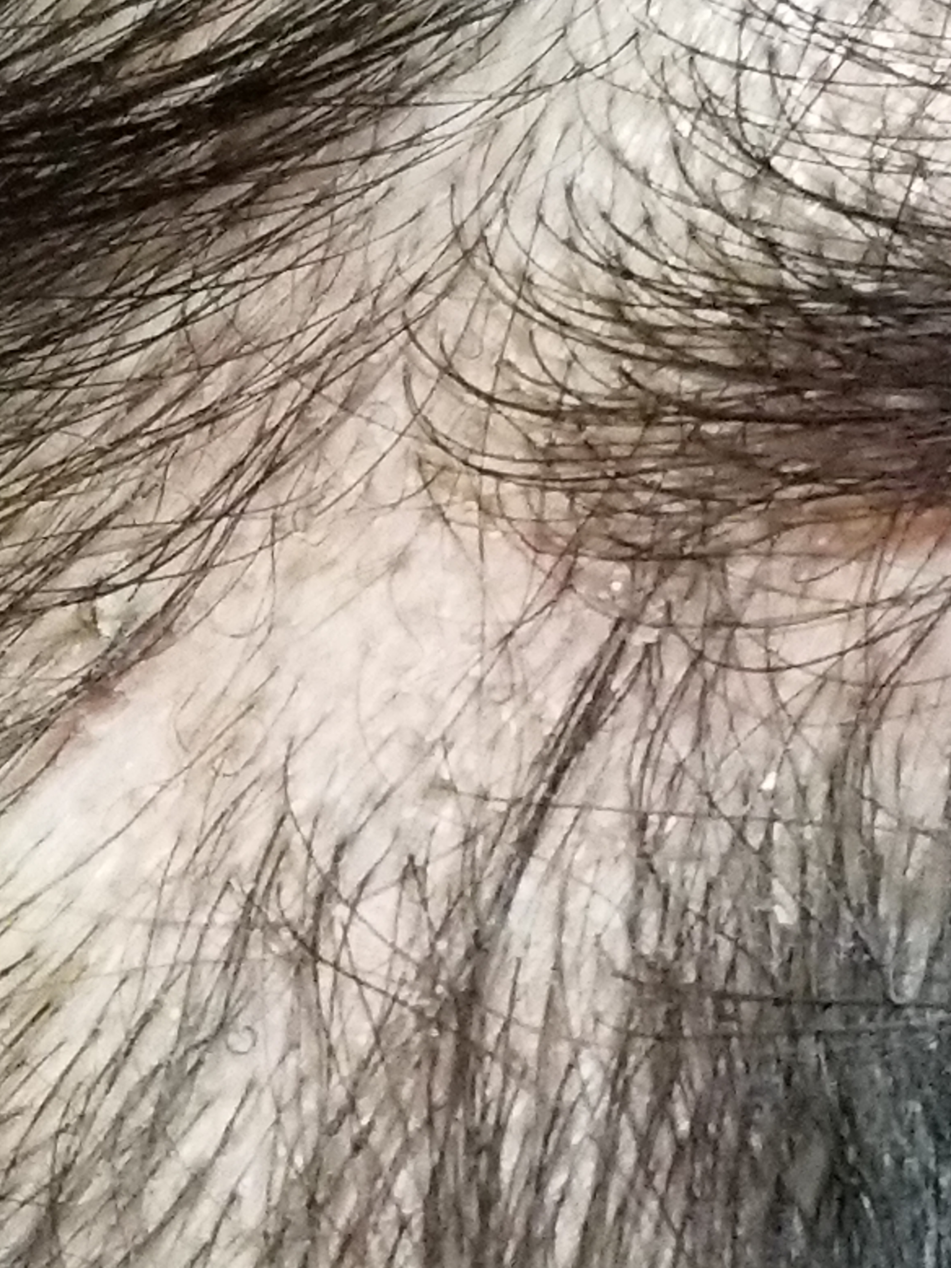 androgenic alopecia