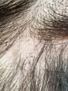 androgenic alopecia