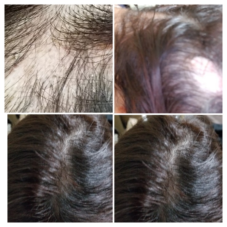 Alopecia