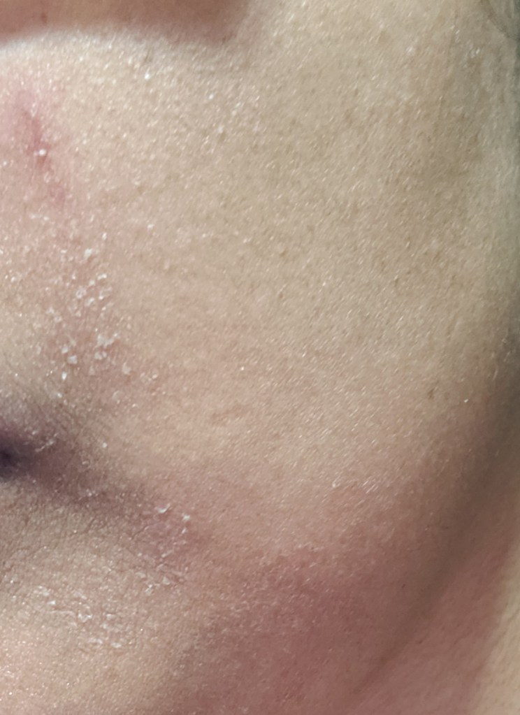 Sensitive Skin