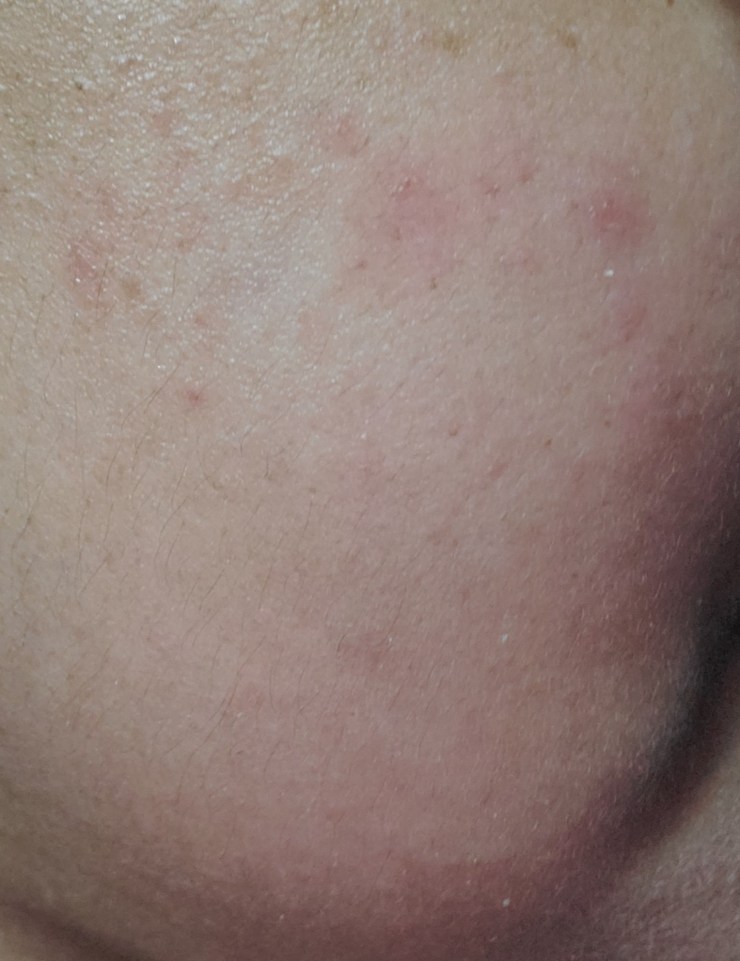 rashes