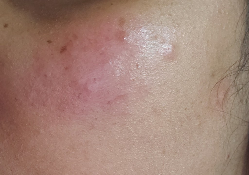 rashes